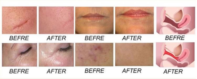 Laser Equipment CO2 Fractional/ CO2 Fractional Laser Vaginal Tightening Beauty Salon Equipment